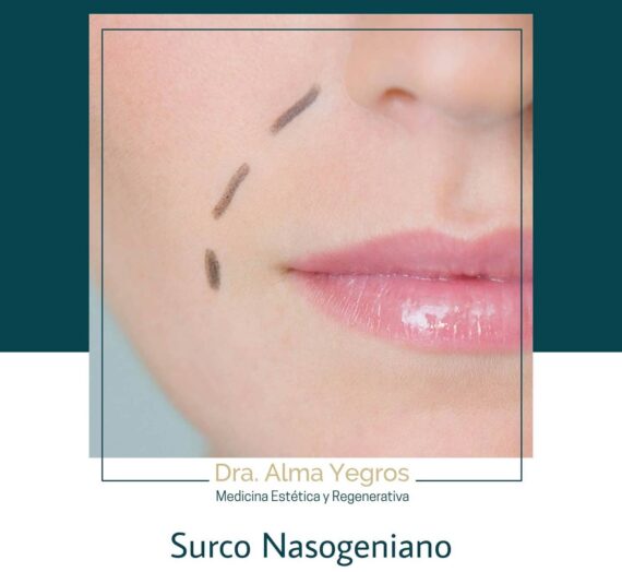 SURCO NASOGENIANO
